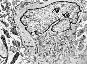 F, 49y. | myelosarcoma … histiocyte-like cells in dermal infiltrates F, 49y. | myelosarcoma … histiocyte-like cells in dermal infiltrates